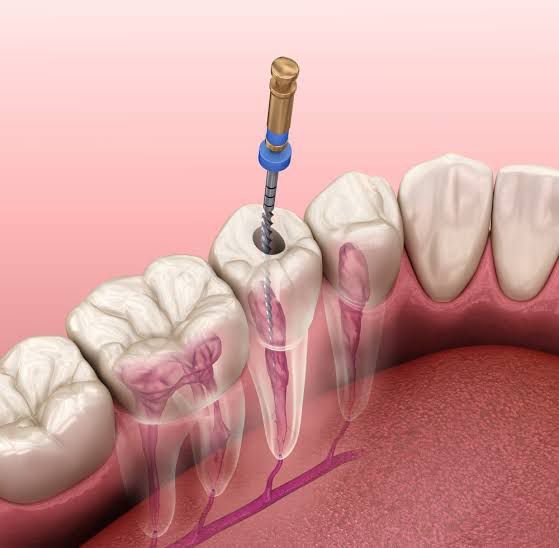 Signs You Might Need a Root Canal What to Watch For